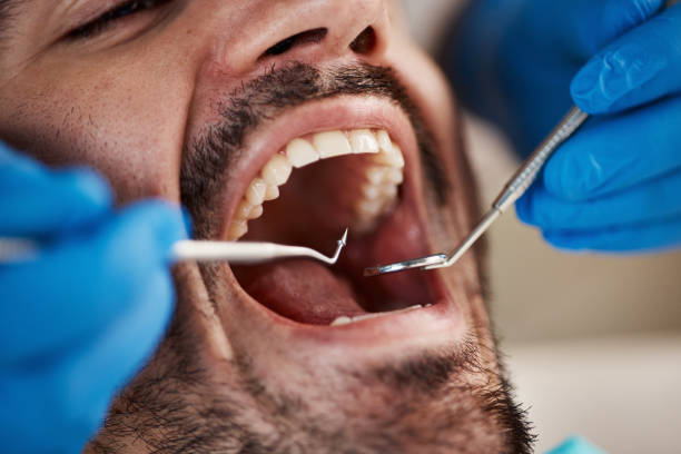 Best Knocked-Out Tooth (Avulsed Tooth) Treatment in Millville, NJ